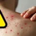 Acciones preventivas por brote de sarampión