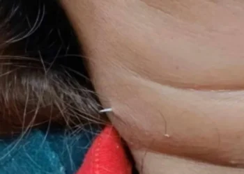 Nuevo miedo desbloqueado: Comió pescado y le salió una espina del cuello